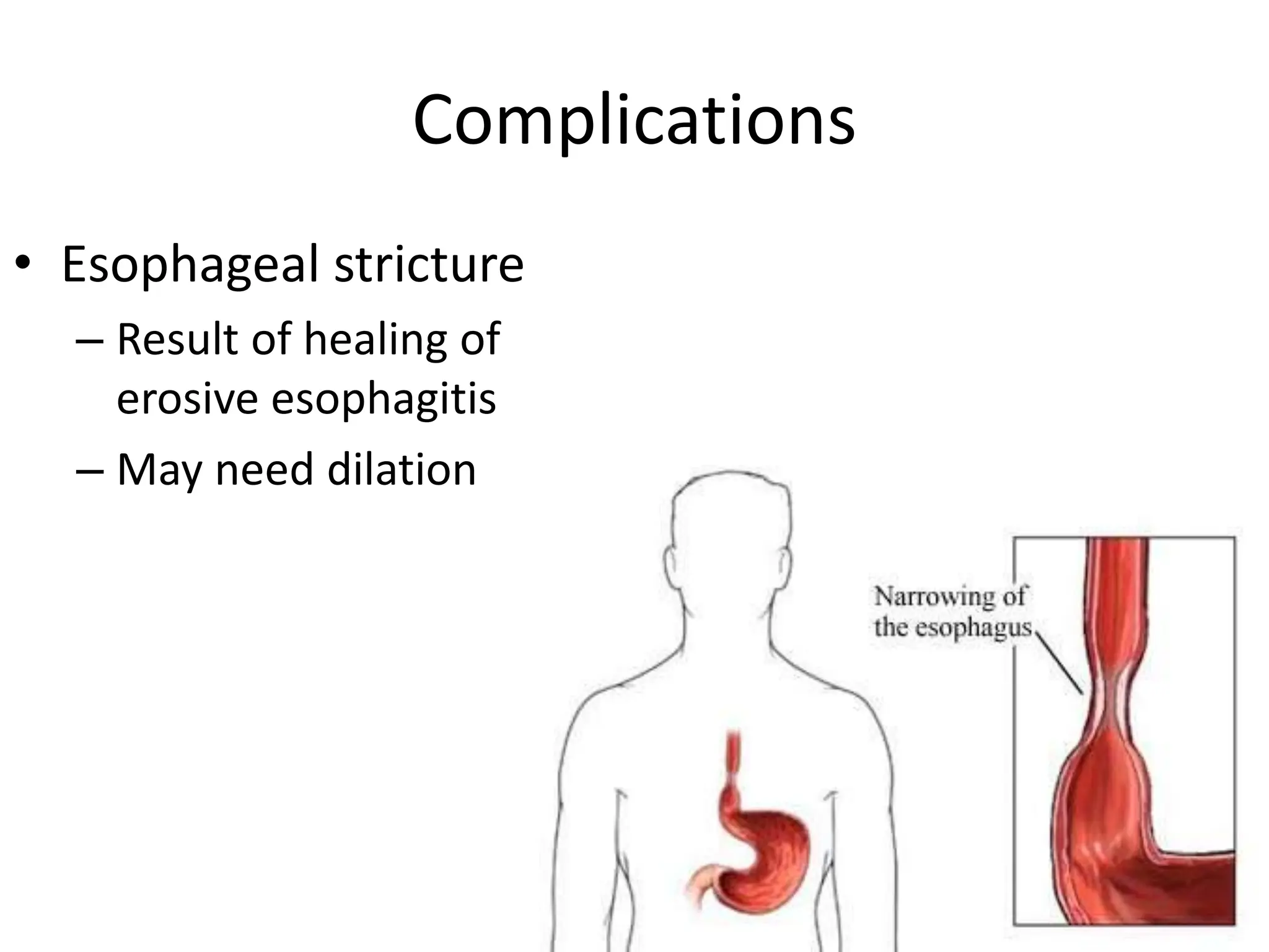 Complications
• Esophageal stricture
– Result of healing of
erosive esophagitis
– May need dilation
 