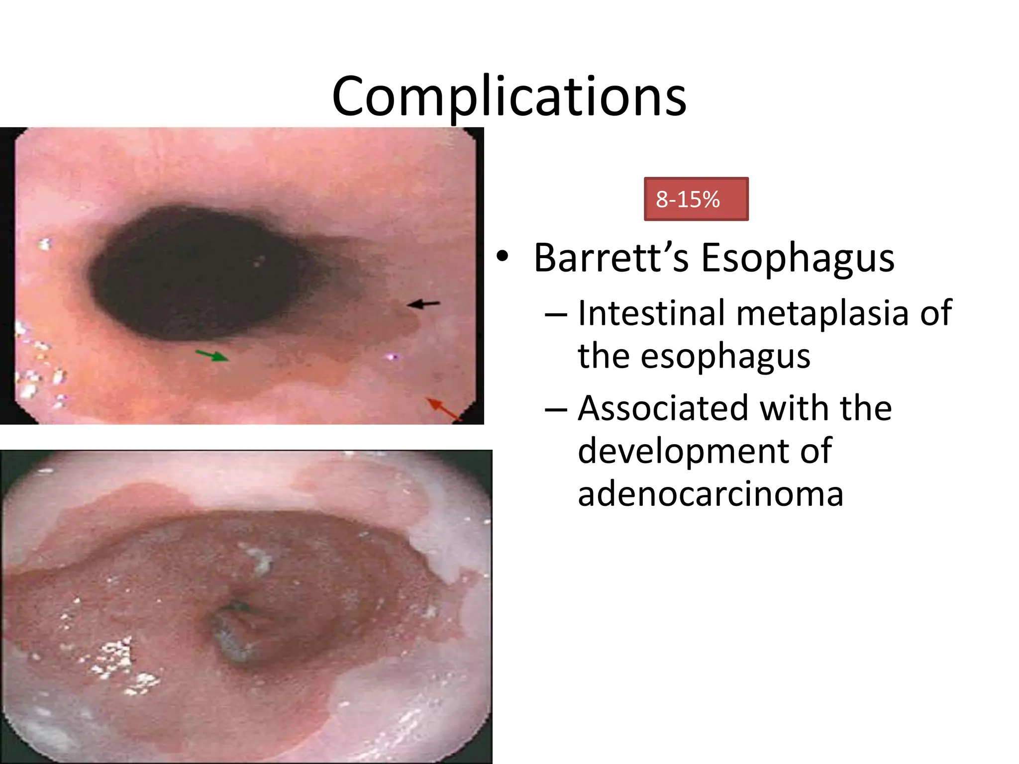 Complications
• Barrett’s Esophagus
– Intestinal metaplasia of
the esophagus
– Associated with the
development of
adenocarcinoma
8-15%
 