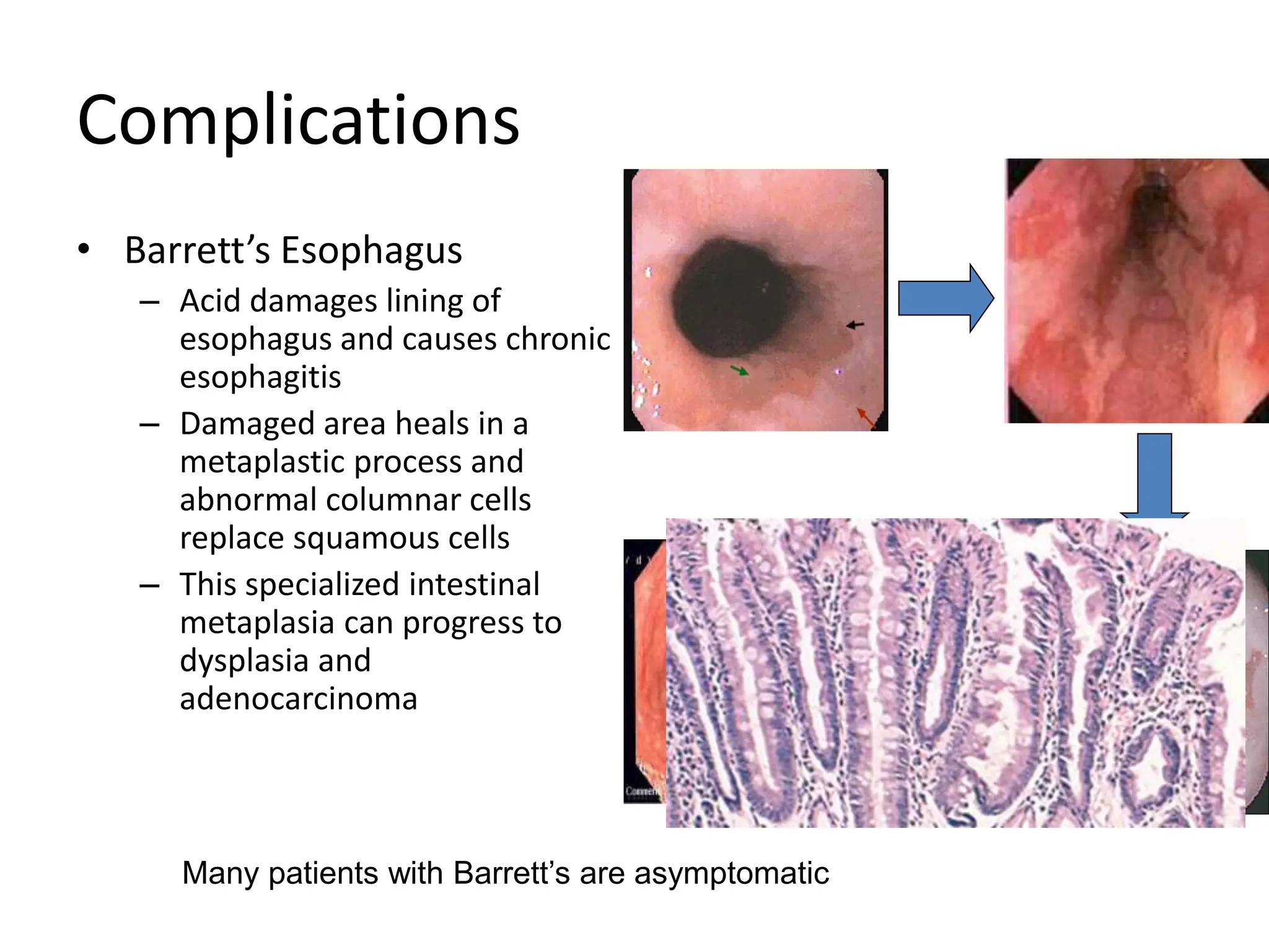 Complications
• Barrett’s Esophagus
– Acid damages lining of
esophagus and causes chronic
esophagitis
– Damaged area heals in a
metaplastic process and
abnormal columnar cells
replace squamous cells
– This specialized intestinal
metaplasia can progress to
dysplasia and
adenocarcinoma
Many patients with Barrett’s are asymptomatic
 