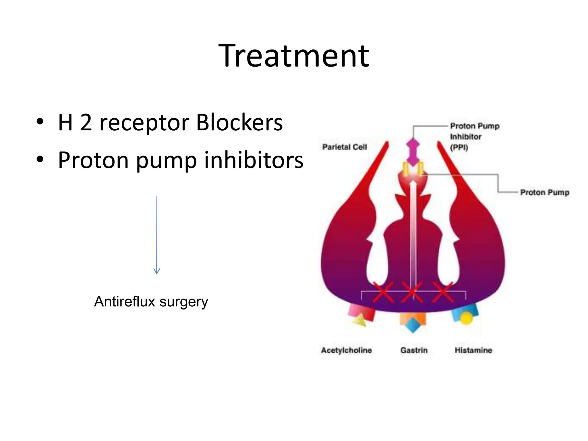 Treatment
• H 2 receptor Blockers
• Proton pump inhibitors
Antireflux surgery
 