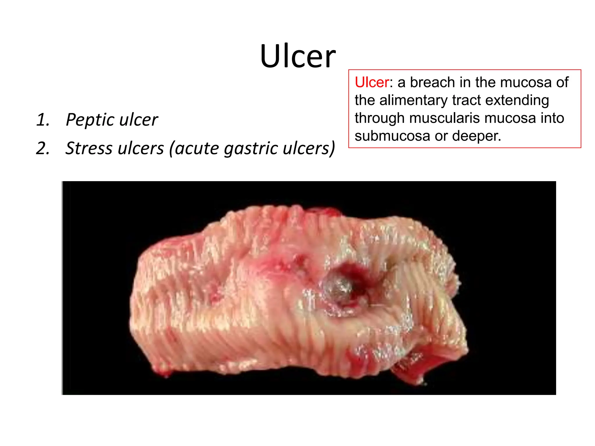 Ulcer
1. Peptic ulcer
2. Stress ulcers (acute gastric ulcers)
Ulcer: a breach in the mucosa of
the alimentary tract extending
through muscularis mucosa into
submucosa or deeper.
 