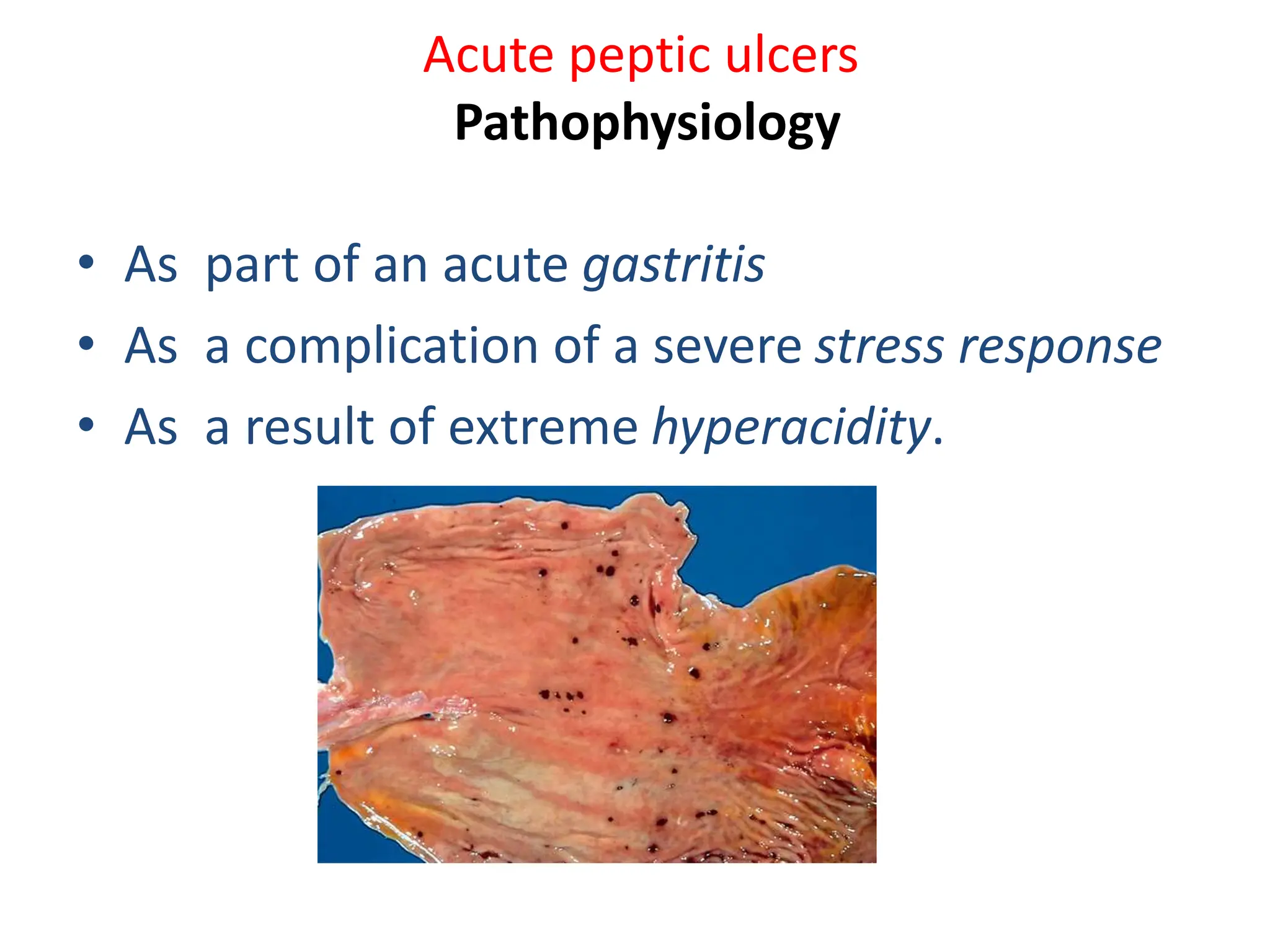 Acute peptic ulcers
Pathophysiology
• As part of an acute gastritis
• As a complication of a severe stress response
• As a result of extreme hyperacidity.
 