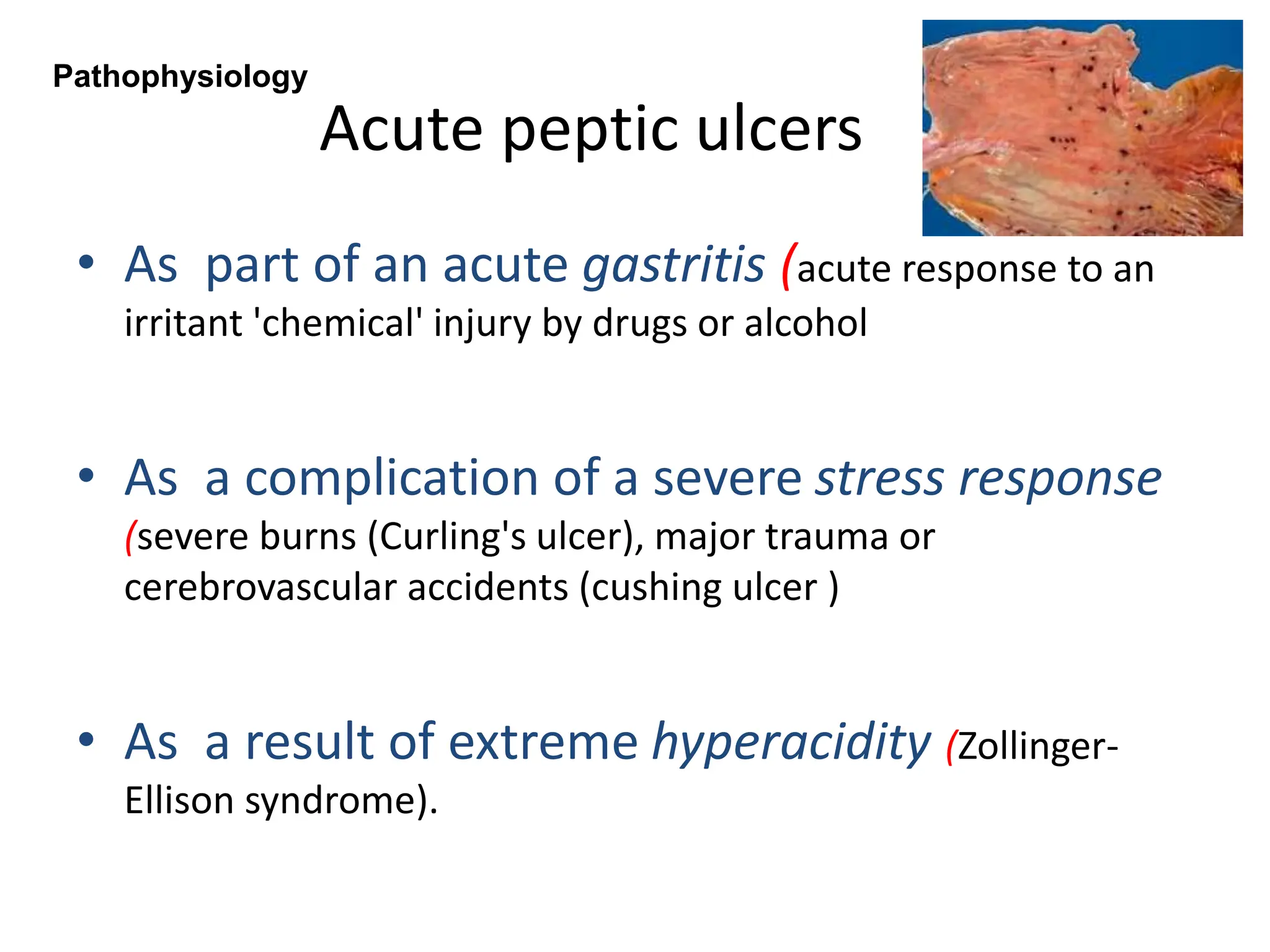 Acute peptic ulcers
• As part of an acute gastritis (acute response to an
irritant 'chemical' injury by drugs or alcohol
• As a complication of a severe stress response
(severe burns (Curling's ulcer), major trauma or
cerebrovascular accidents (cushing ulcer )
• As a result of extreme hyperacidity (Zollinger-
Ellison syndrome).
Pathophysiology
 