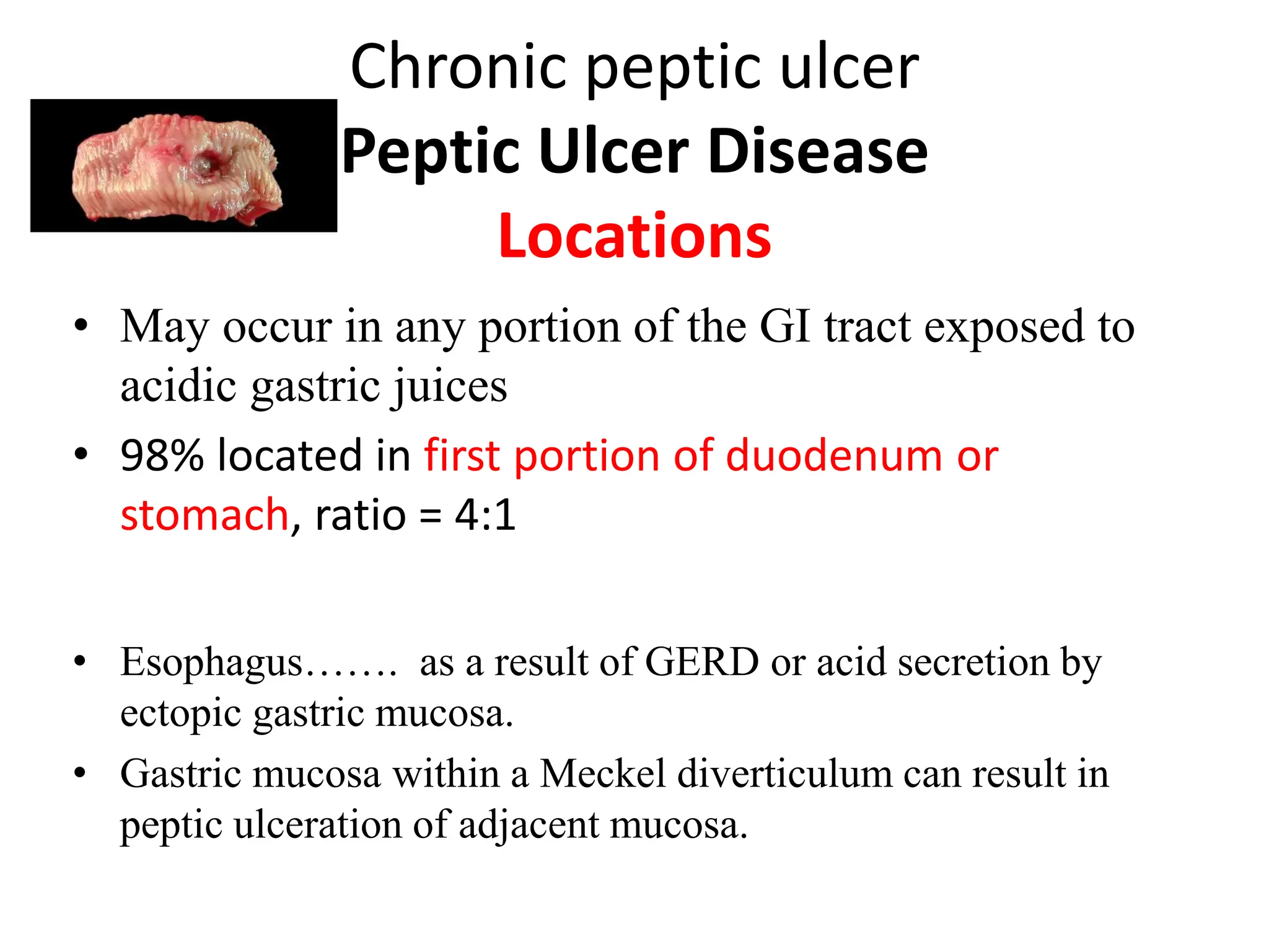Chronic peptic ulcer
Peptic Ulcer Disease
Locations
• May occur in any portion of the GI tract exposed to
acidic gastric juices
• 98% located in first portion of duodenum or
stomach, ratio = 4:1
• Esophagus……. as a result of GERD or acid secretion by
ectopic gastric mucosa.
• Gastric mucosa within a Meckel diverticulum can result in
peptic ulceration of adjacent mucosa.
 