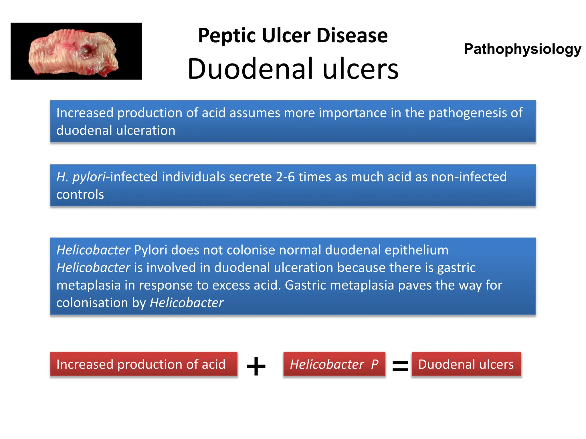 Peptic Ulcer Disease
Duodenal ulcers
Increased production of acid assumes more importance in the pathogenesis of
duodenal ulceration
H. pylori-infected individuals secrete 2-6 times as much acid as non-infected
controls
Helicobacter Pylori does not colonise normal duodenal epithelium
Helicobacter is involved in duodenal ulceration because there is gastric
metaplasia in response to excess acid. Gastric metaplasia paves the way for
colonisation by Helicobacter
Pathophysiology
Increased production of acid Helicobacter P
+
= Duodenal ulcers
 