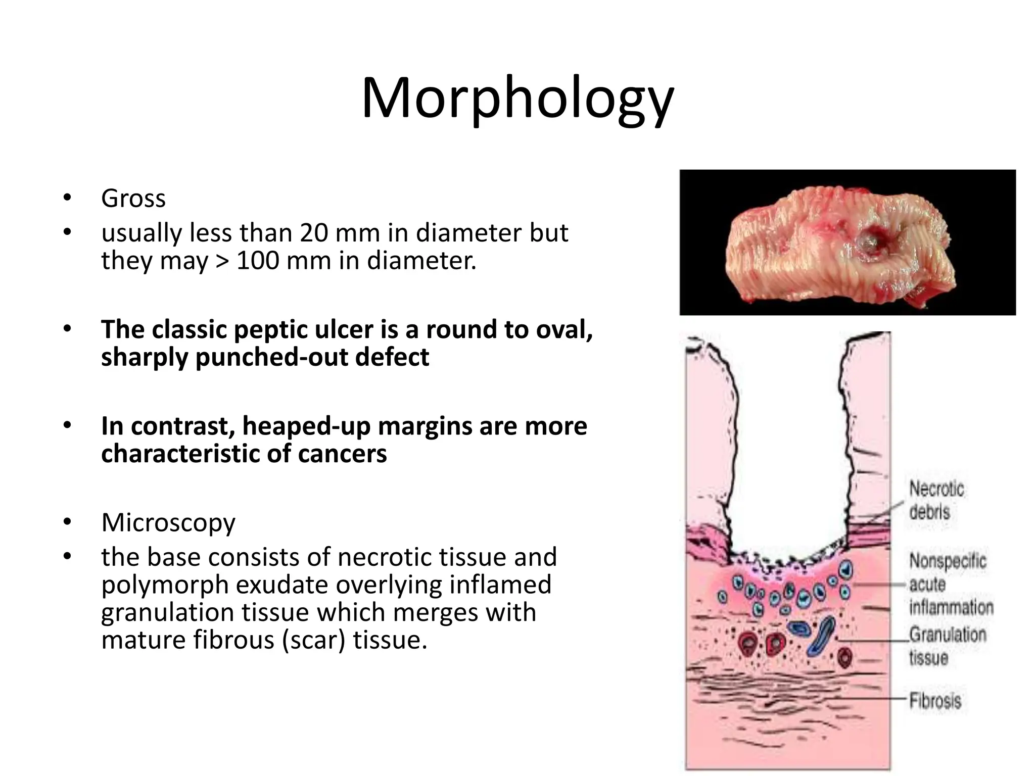 Morphology
• Gross
• usually less than 20 mm in diameter but
they may > 100 mm in diameter.
• The classic peptic ulcer is a round to oval,
sharply punched-out defect
• In contrast, heaped-up margins are more
characteristic of cancers
• Microscopy
• the base consists of necrotic tissue and
polymorph exudate overlying inflamed
granulation tissue which merges with
mature fibrous (scar) tissue.
 