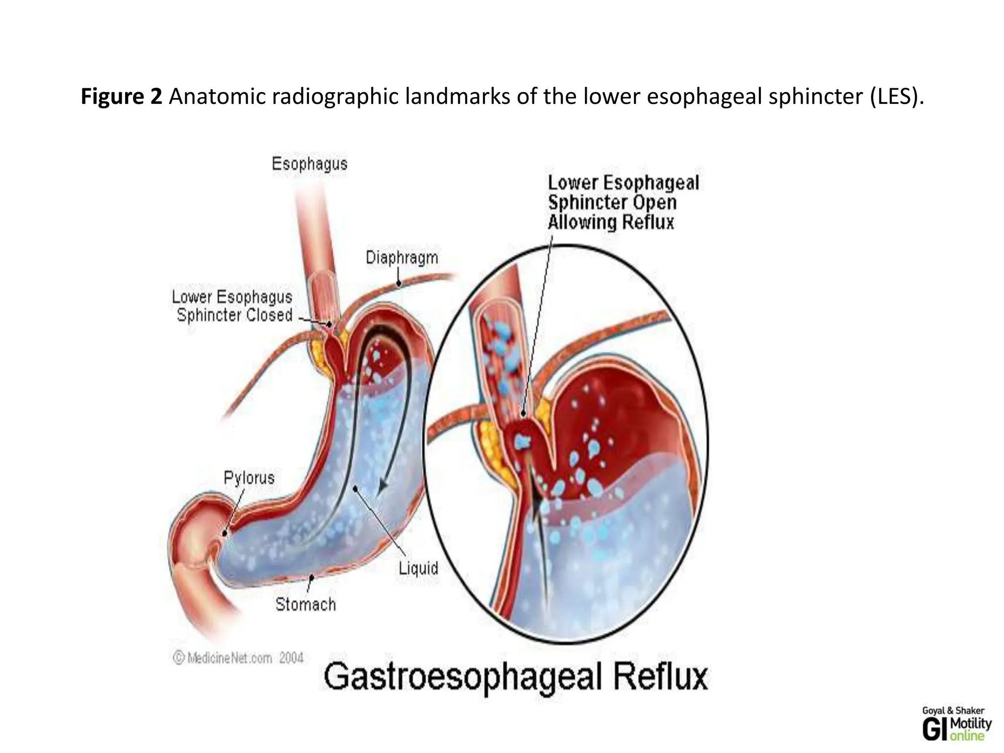 Figure 2 Anatomic radiographic landmarks of the lower esophageal sphincter (LES).
 