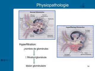 14
Physiopathologie
Hyperfiltration:
↓nombre de glomérules
↑ filtration/glomérule
lésion glomérulaire
 