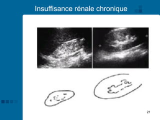 21
Insuffisance rénale chronique
 