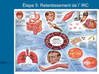 35
Étape 5: Retentissement de l’IRC
 