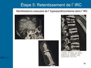 36
Étape 5: Retentissement de l’IRC
Manifestations osseuses de l’hyperparathyroïdisme dans l’IRC
 