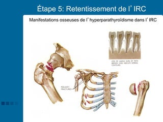 37
Étape 5: Retentissement de l’IRC
Manifestations osseuses de l’hyperparathyroïdisme dans l’IRC
 