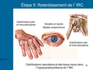 38
Étape 5: Retentissement de l’IRC
Calcifications vasculaires et des tissus mous dans
l’hyperparathyroïdisme de l’IRC
Calcifications péri
et intra-articulaires
Kératite en bande
Dépôts conjonctivaux
Calcifications péri
et intra-articulaires
 