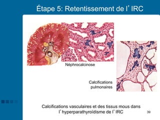 39
Étape 5: Retentissement de l’IRC
Calcifications vasculaires et des tissus mous dans
l’hyperparathyroïdisme de l’IRC
Néphrocalcinose
Calcifications
pulmonaires
 