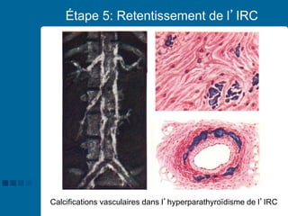 40
Étape 5: Retentissement de l’IRC
Calcifications vasculaires dans l’hyperparathyroïdisme de l’IRC
 