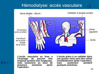59
Hémodialyse: accès vasculaire
Cathéter à double lumière
Veine dilatée - Shunt -
Connection
veine et artère
Fermeture
de la sortie
distale
de la veine
Veine
jugulaire
Aorte
L‘accès vasculaire au bras a
l‘avantage de pouvoir être
employé pendant très longtemps,
mais seulement au bout de
plusieurs semaines après
l‘opération.
L‘accès grâce à un cathéter dans
une grosse veine peut être utilisé
immédiatement après l‘opération,
mais seulement pendant
quelques semaines.
 