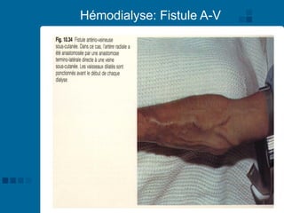 60
Hémodialyse: Fistule A-V
 