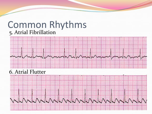 12 Lead EKG Interpretation