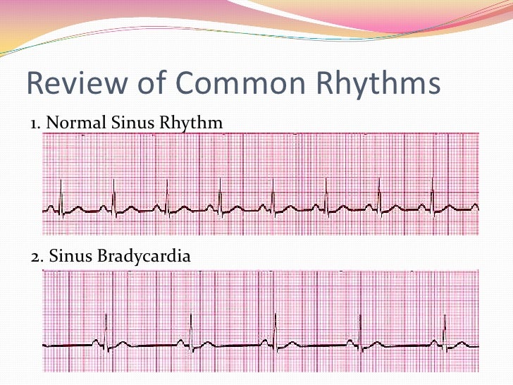 12 Lead EKG Interpretation