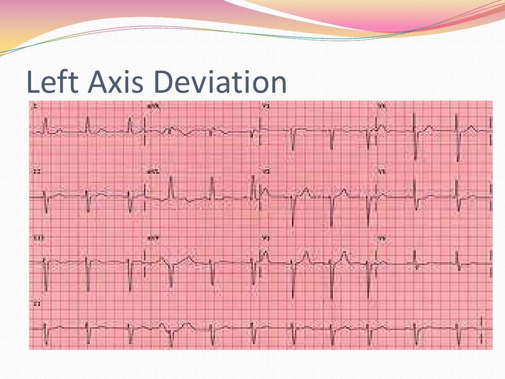 12 Lead ECG Tracing