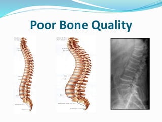 Back pain common causes and prevention | PPTX