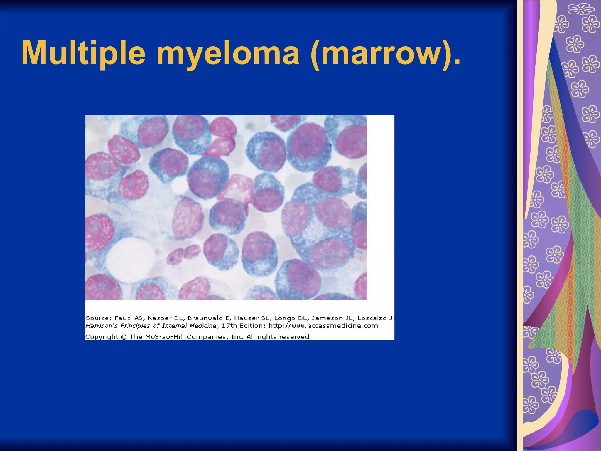 Multiple myeloma (marrow).   