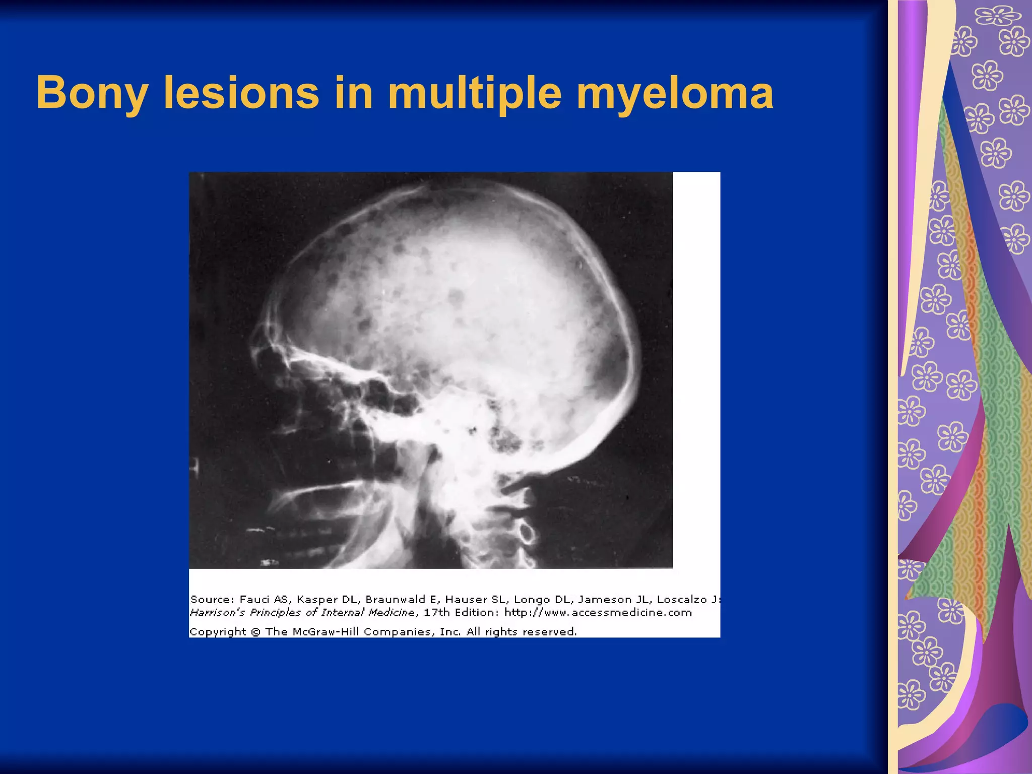 Bony lesions in multiple myeloma   