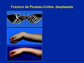 Fractura de Pouteau-Colles: desplazada 