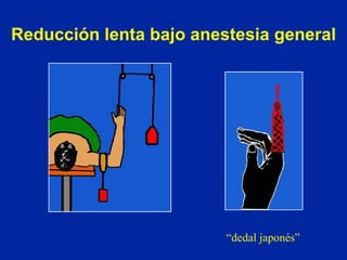 Reducción lenta bajo anestesia general “ dedal japonés” 