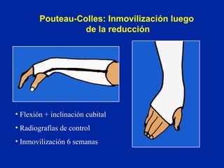 Pouteau-Colles: Inmovilización luego  de la reducción Flexión + inclinación cubital Radiografías de control Inmovilización 6 semanas 