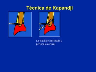 Técnica de Kapandji La clavija es inclinada y perfora la cortical 