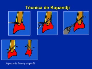 Técnica de Kapandji Aspecto de frente y de perfil 