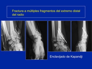 Fractura a múltiples fragmentos del extremo distal del radio Enclavijado de Kapandji 