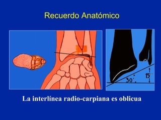 La interlínea radio-carpiana es oblicua Recuerdo Anatómico 