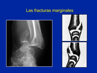 Las fracturas marginales 