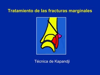 Tratamiento de las fracturas marginales   Técnica de Kapandji 