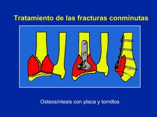 Tratamiento de las fracturas conminutas Osteosíntesis con placa y tornillos 