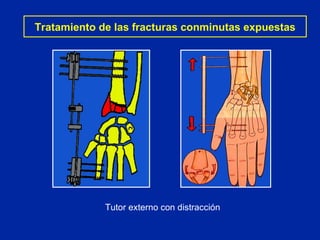 Tratamiento de las fracturas conminutas expuestas Tutor externo con distracción 