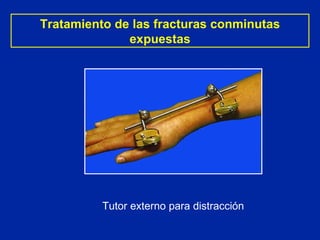 Tratamiento de las fracturas conminutas expuestas Tutor externo para distracción 