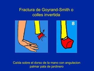 Fractura de Goyrand-Smith o colles invertida Caída sobre el dorso de la mano con angulacion palmar pala de jardinero 