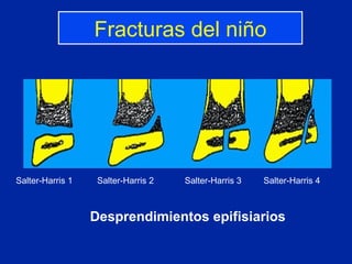 Desprendimientos epifisiarios Salter-Harris 1  Salter-Harris 2   Salter-Harris 3  Salter-Harris 4 Fracturas del niño 