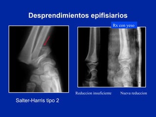 Desprendimientos epifisiarios Reduccion insuficiente   Nueva reduccion Rx con yeso   Salter-Harris tipo 2 