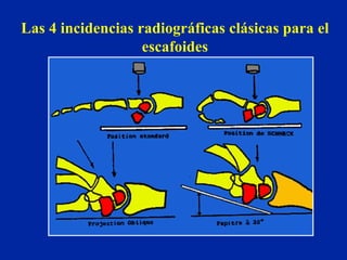 Las 4 incidencias radiográficas clásicas para el escafoides 