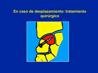 En caso de desplazamiento: tratamiento quirúrgico 