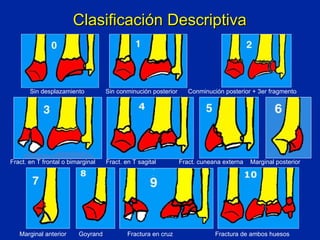 Clasificación Descriptiva Sin desplazamiento  Sin conminución posterior  Conminución posterior + 3er fragmento Fract. en T frontal o bimarginal  Fract. en T sagital  Fract. cuneana externa  Marginal posterior   Marginal anterior  Goyrand  Fractura en cruz  Fractura de ambos huesos 