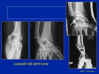Luxación del semi lunar fotos J. Chouteau 