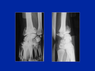 25600 Comprehensive Overview of Wrist and Distal Radius Fractures: Diagnosis ...