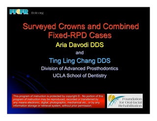 Surveyed Crowns and Combined
             Fixed-RPD Cases
                                   Aria Davodi DDS
                                                    and
                             Ting Ling Chang DDS
                       Division of Advanced Prosthodontics
                             UCLA School of Dentistry



This program of instruction is protected by copyright ©. No portion of this
program of instruction may be reproduced, recorded or transferred by
any means electronic, digital, photographic, mechanical etc., or by any
information storage or retrieval system, without prior permission.
 