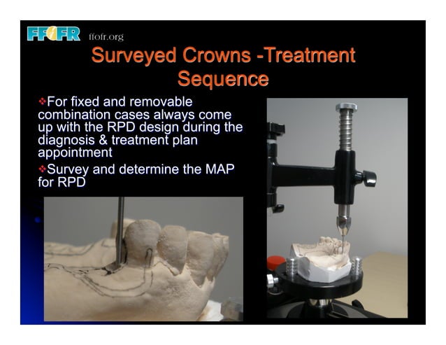Crown Rpd 12.(new)surveyed crowns and combined fixed rpd cases | PDF
