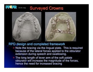 Crown Rpd Rest 12.(new)surveyed crowns and combined fixed rpd cases | PDF
